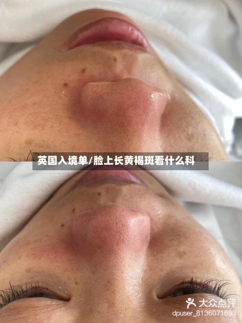 英国入境单/脸上长黄褐斑看什么科-第2张图片