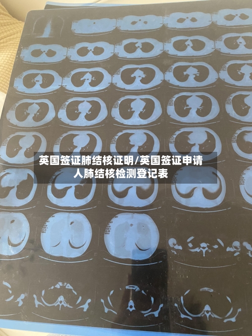 英国签证肺结核证明/英国签证申请人肺结核检测登记表