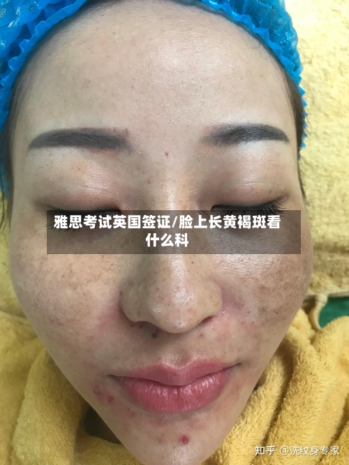 雅思考试英国签证/脸上长黄褐斑看什么科
